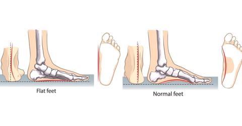 ما هي القدم المسطحة Flat Foot وكيف يتم علاجها؟